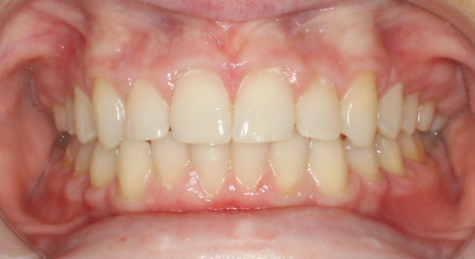 After Image of dental work