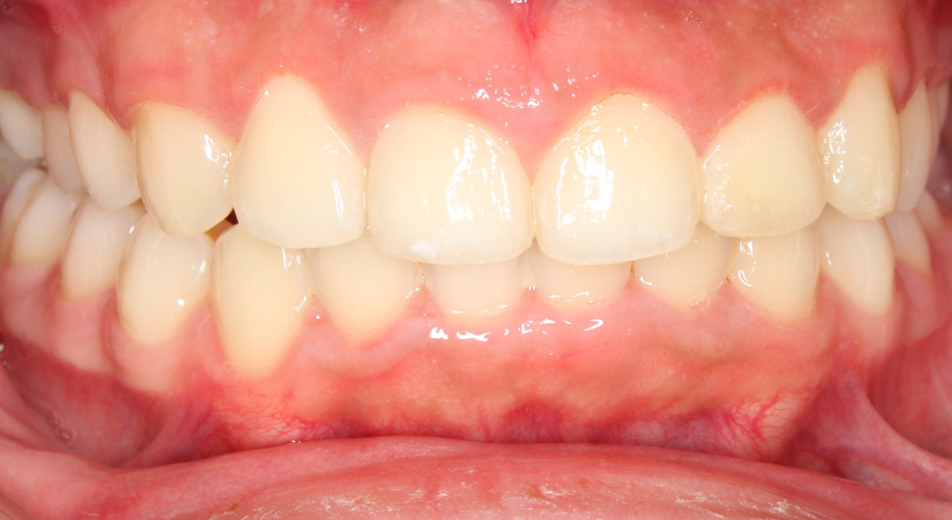 After Image of dental work