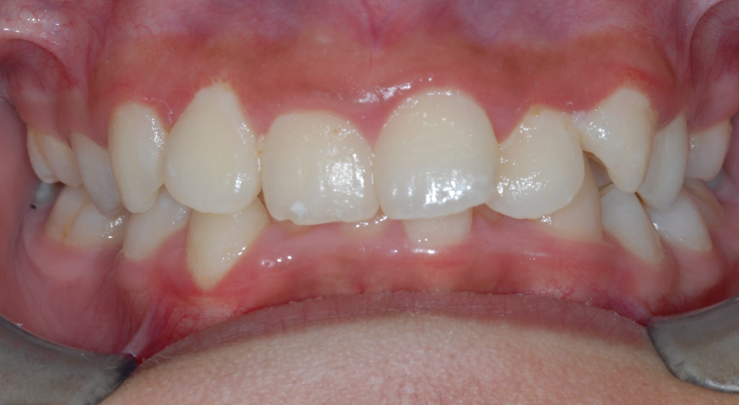 Before Image of dental work