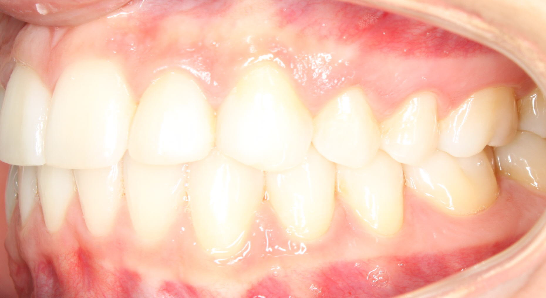 After Image of dental work