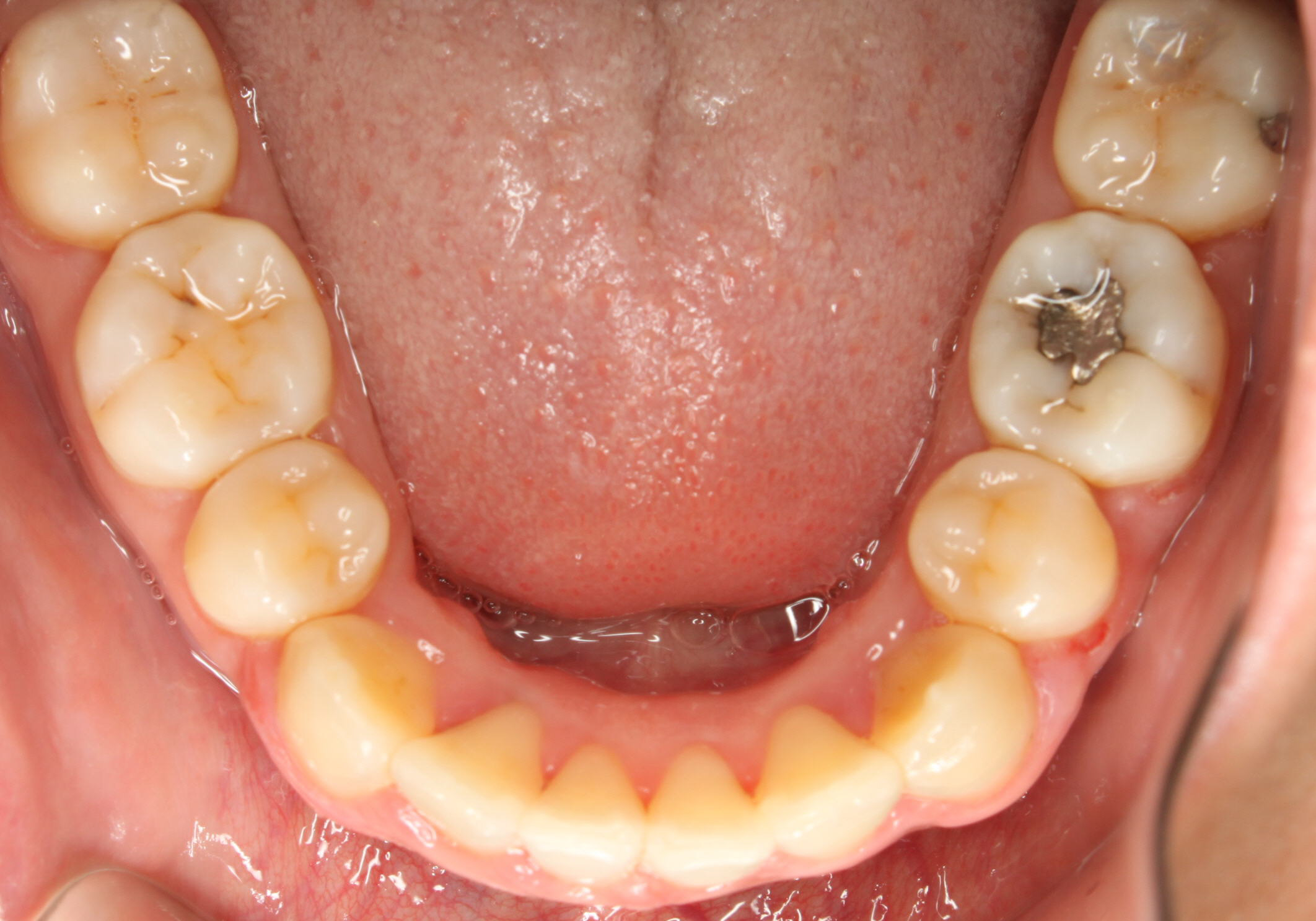 After Image of dental work