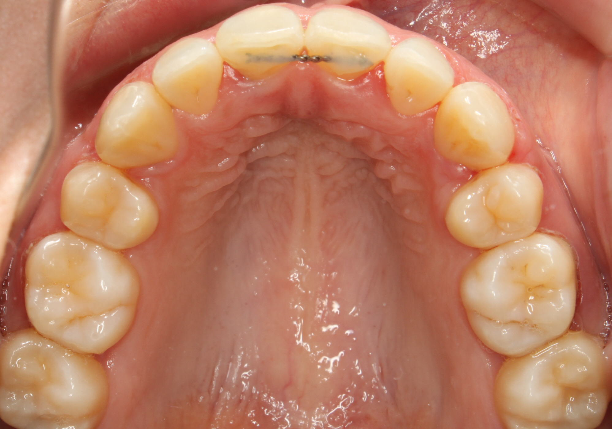 After Image of dental work