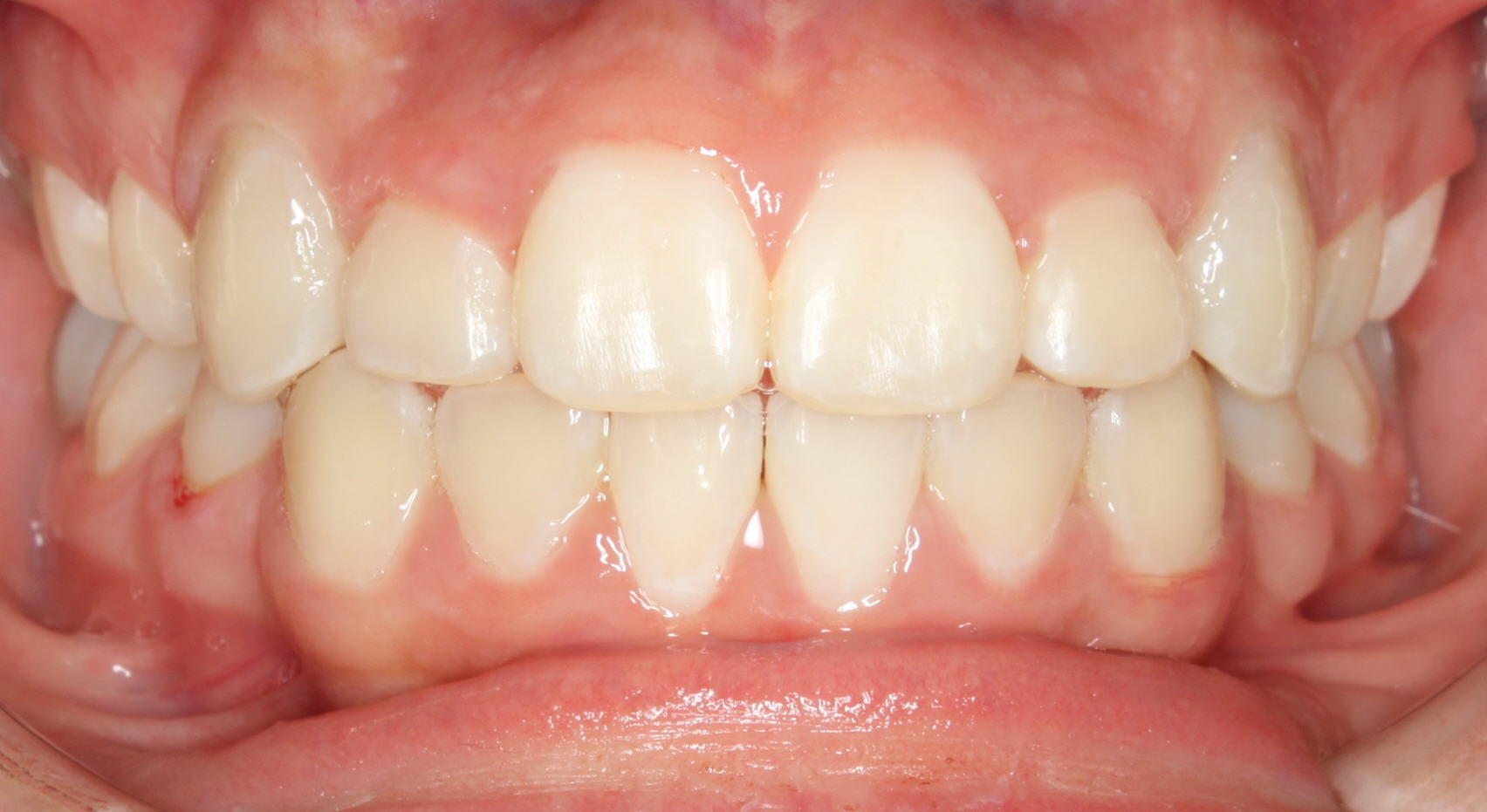 After Image of dental work