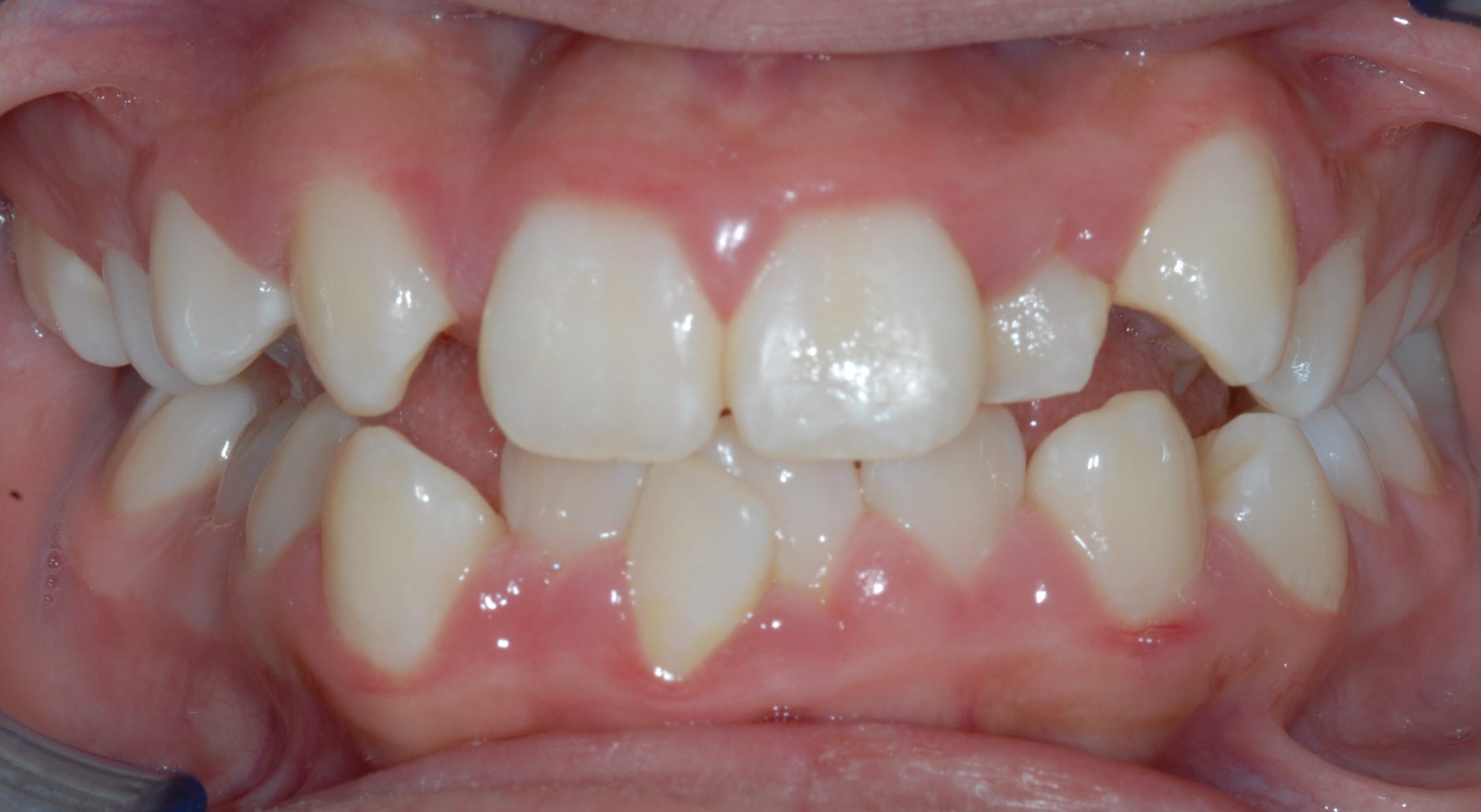 Before Image of dental work