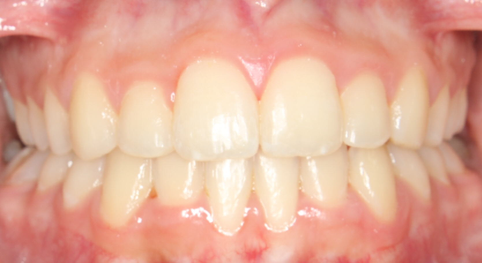 After Image of dental work