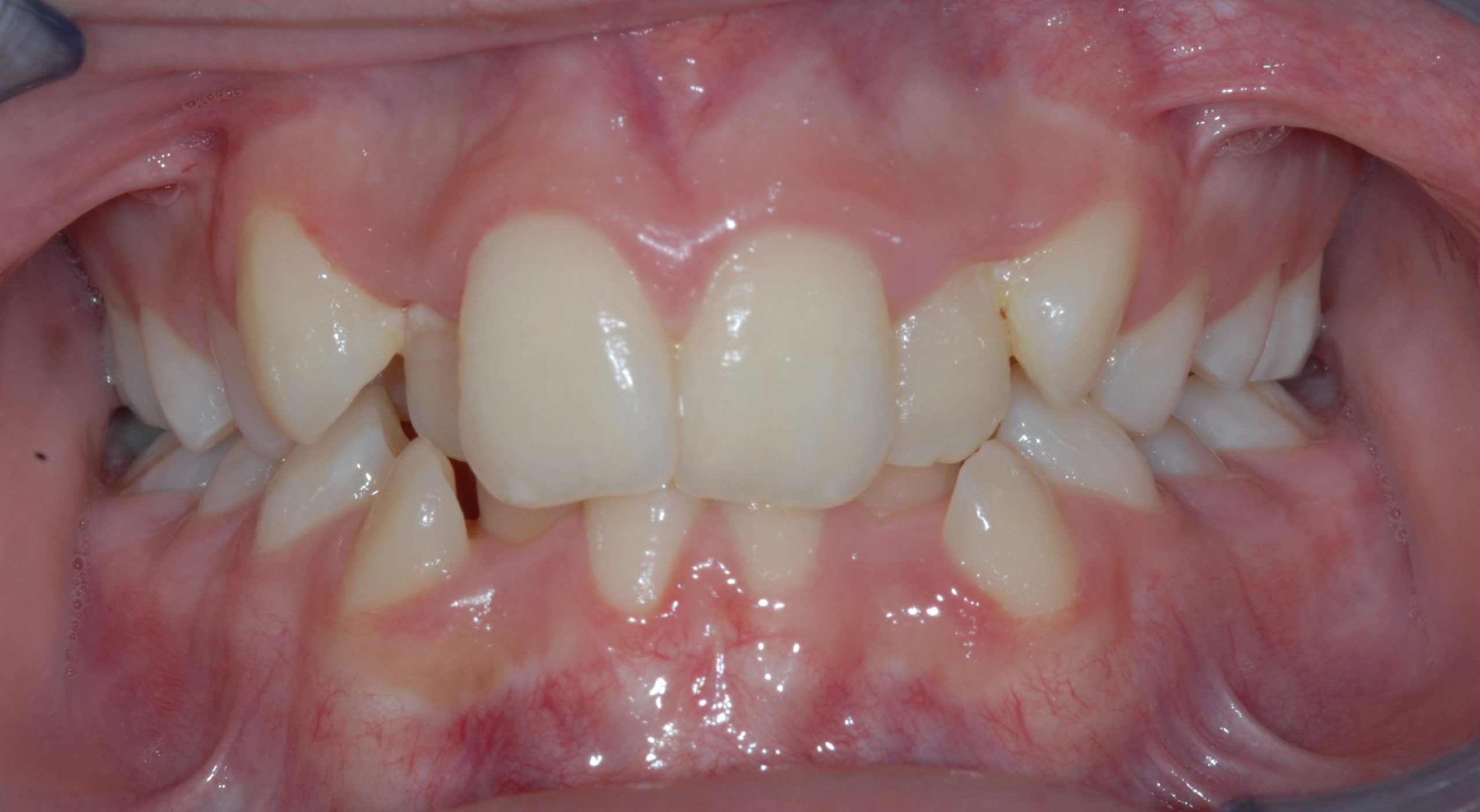 Before Image of dental work